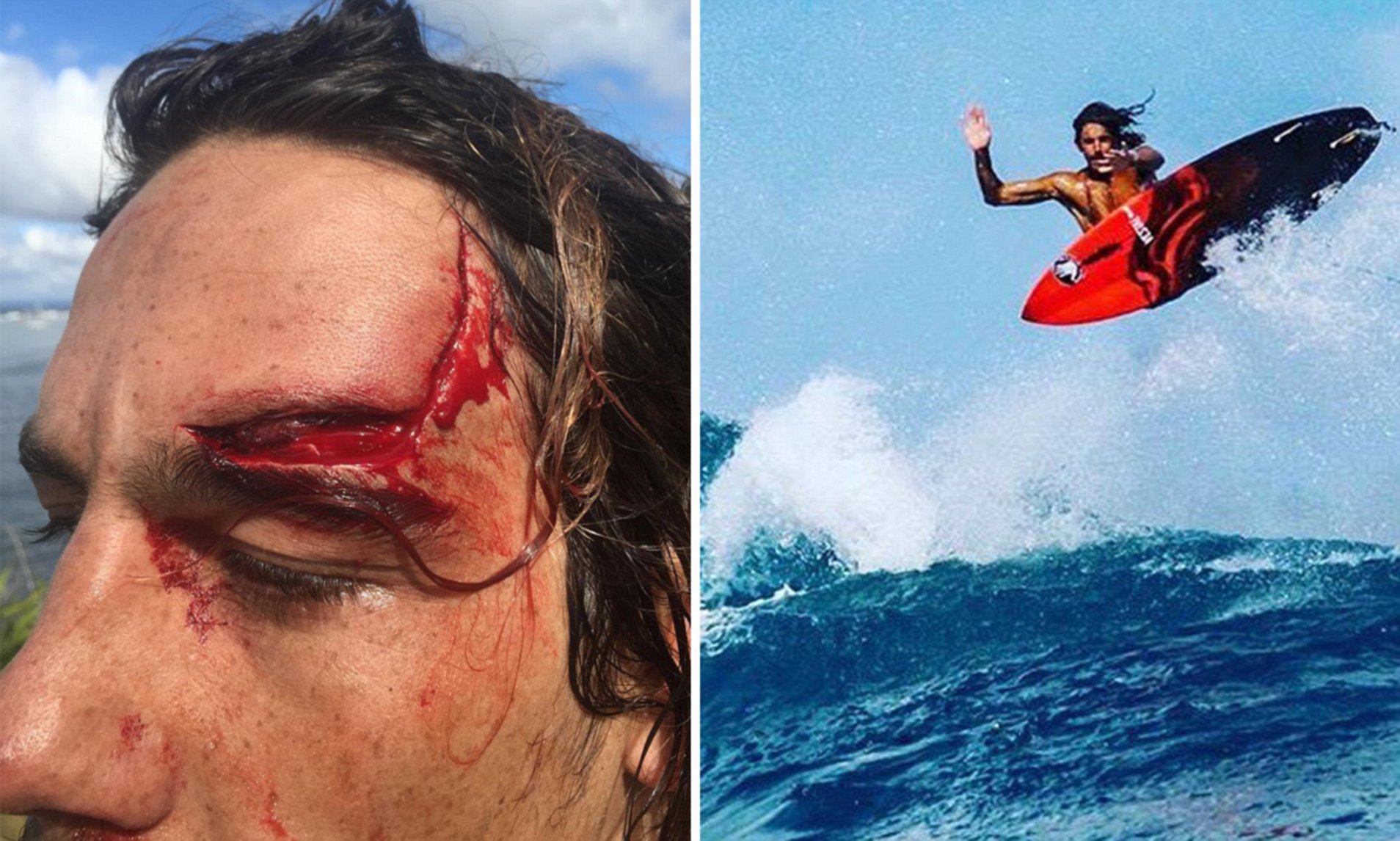 Injury of Head surfing